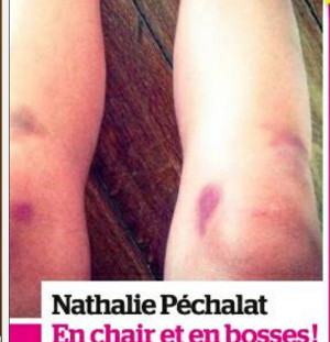 Nathalie Péchalat, ses bobos DALS