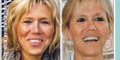  Brigitte Macron a eu recours au service d'un orthodontiste (photo)