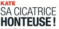 Kate Middelton, « sa cicatrice honteuse » (photo)