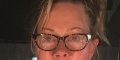 Melanie Griffith choque avec une photo de son visage défiguré par une tumeur