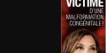 Zazie victime d'une malformation congénitale, révélation sur sa maladie