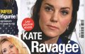 Kate Middleton ravagée par une impitoyable maladie selon France Dimanche