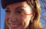 Kate Middleton : le mystère de son « immense cicatrice » au visage 