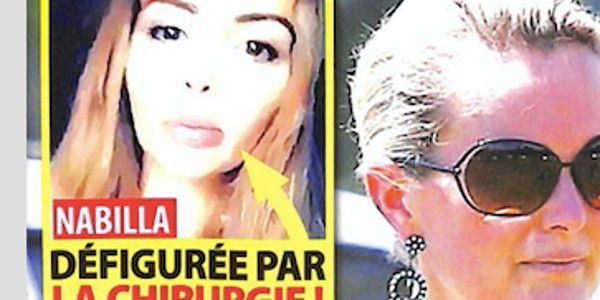 Nabilla Benattia défigurée par la chirurgie ?