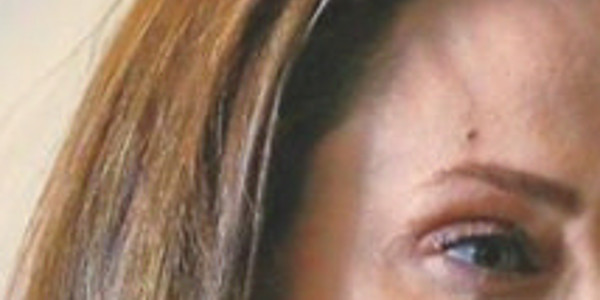 Angelina Jolie défigurée par une opération ratée, la photo choc