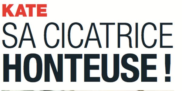 Kate Middelton, « sa cicatrice honteuse » (photo)