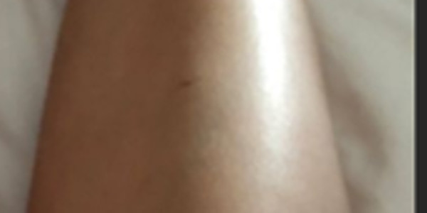Nathalie Péchalat, vacances gâchées, horrible blessure, photo choc