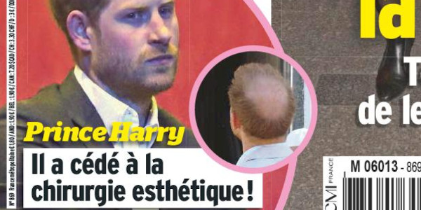 Prince Harry, chirurgie esthétique, relooking extrême imposés par Meghan Markle