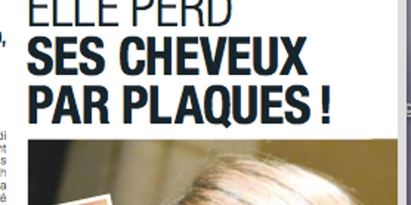 Sylvie Tellier sous pression, elle perd ses cheveux par plaques (photo)