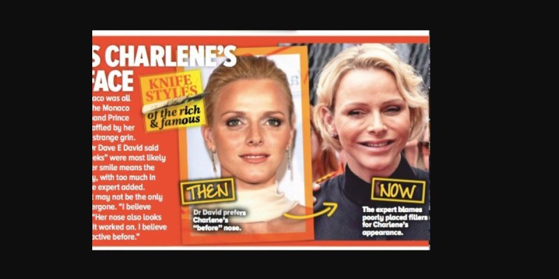 Charlène de Monaco opération de chirurgie esthétique loupée, cette intervention qu'elle n'a jamais osé