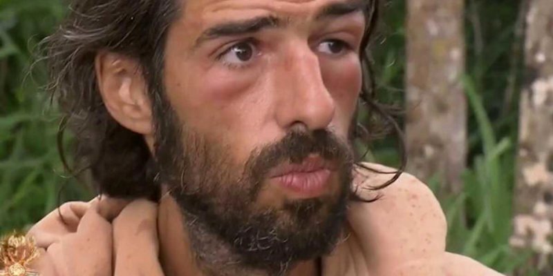 Mystérieux gonflement des yeux dans Koh-Lanta : Esteban en danger ? œdème de Quincke ?