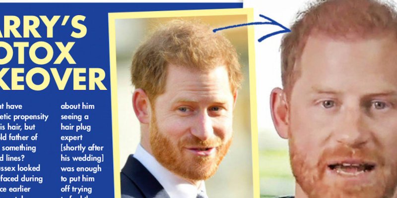Prince Harry, greffe de cheveux, Botox, son teint frais séduit Meghan Markle