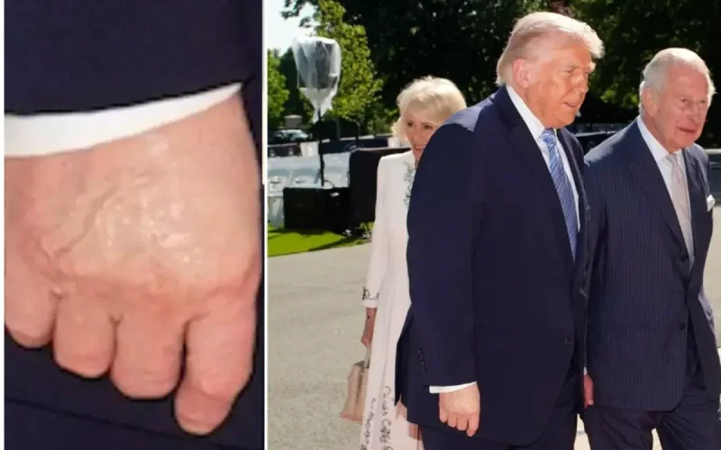 Donald Trump : ce détail physique sur sa main qui a choqué le roi Charles III
