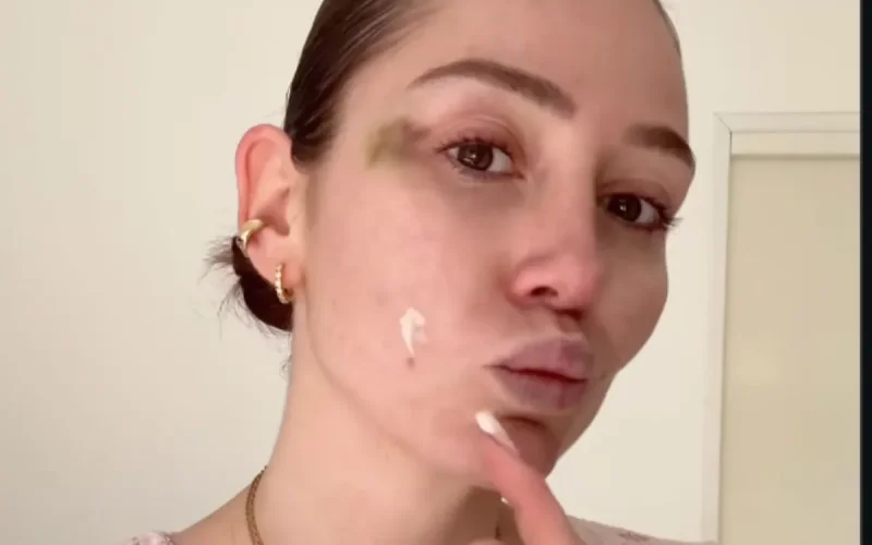 « Une chute accidentelle » : Éloïse Appelle s'explique sur son bleu au visage