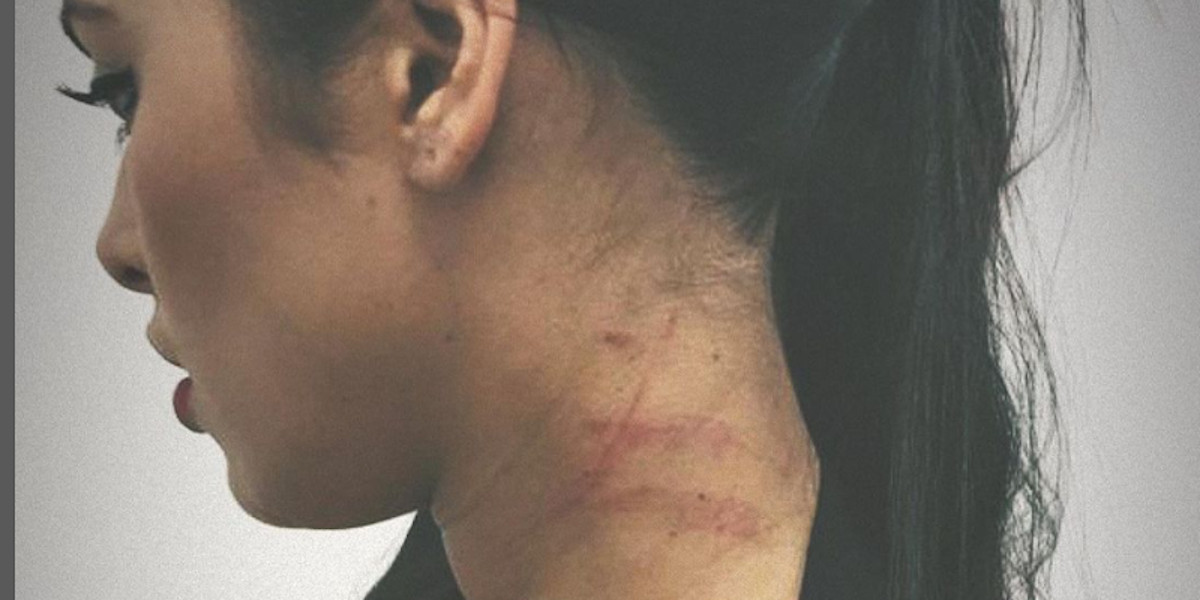 Ayem Nour blessée et battue, un anniversaire cauchemardesque, son accusation contre Vincent Micelet (photo)