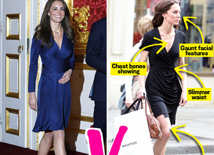 Anorexie kate Middleton