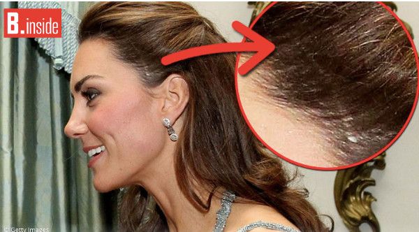 Kate Middleton, une photo choc de sa cicatrice dévoilée